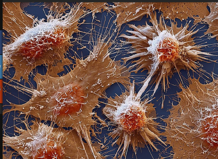 cancer cells under electron microscope.png